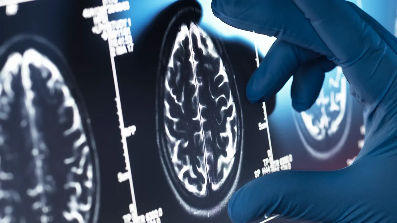 Išorinė imuninė ataka gali skatinti Alzheimerio ligą