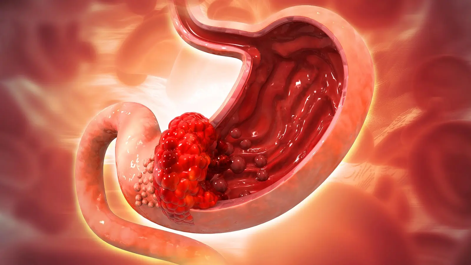 Kaip Helicobacter pylori ilgainiui keičia skrandžio audinį
